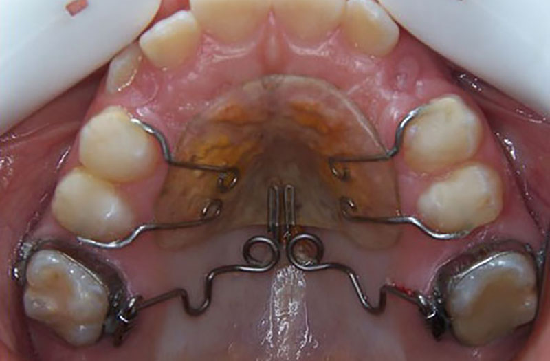 Les appareils d’orthodontie