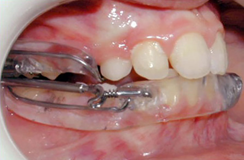 Les appareils d’orthodontie