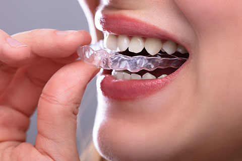 Traitements orthodontiques pour adolescents